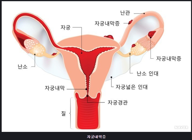 자궁내막증